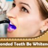 Can Bonded Teeth Be Whitened