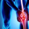 Osteoarthritis Treatment