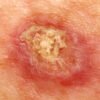 How Do You Know If Your Skin Infection Is Skin Cancer?