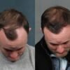 los angeles fue hair transplant clinic