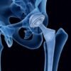 The Dangers of Exactech Knee Replacement: Why You Should Be Worried