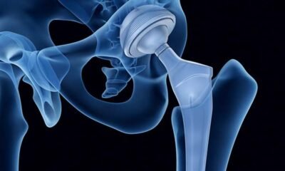 The Dangers of Exactech Knee Replacement: Why You Should Be Worried