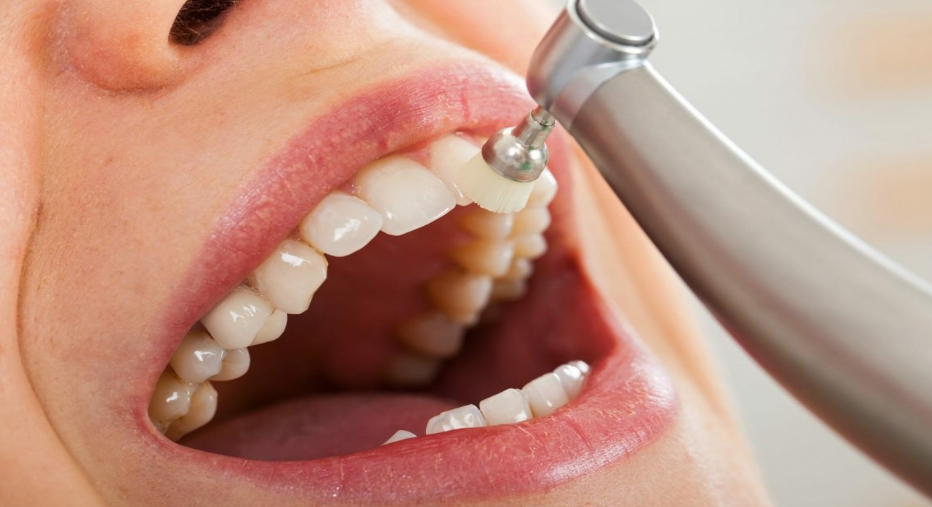 dental teeth cleaning