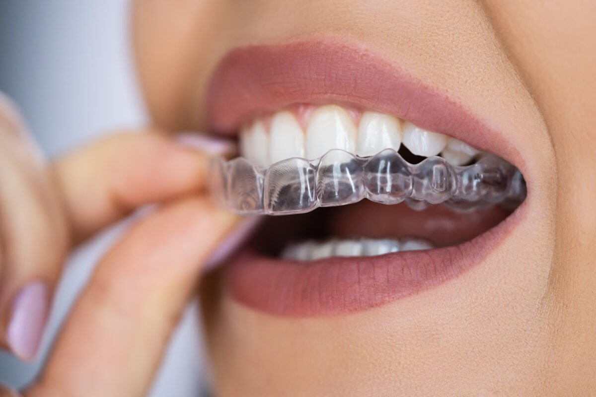 Transform Your Smile with Invisalign Braces in Rochdale: A Comprehensive Guide